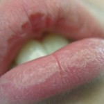 How to Care For Dry Lips